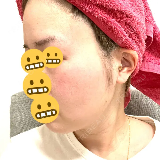 糸リフト / 脂肪吸引（顔） / 脂肪注入（目の下） WOM CLINIC GINZA （ワム クリニック ギンザ） DAY 35 メイン用