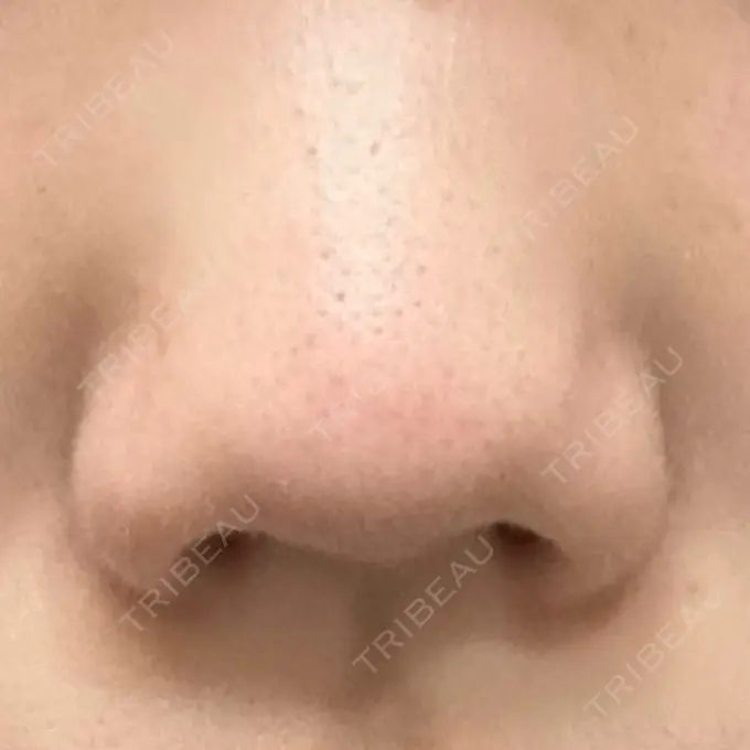鼻尖縮小 リッツ美容外科 大阪院 DAY 6 メイン用