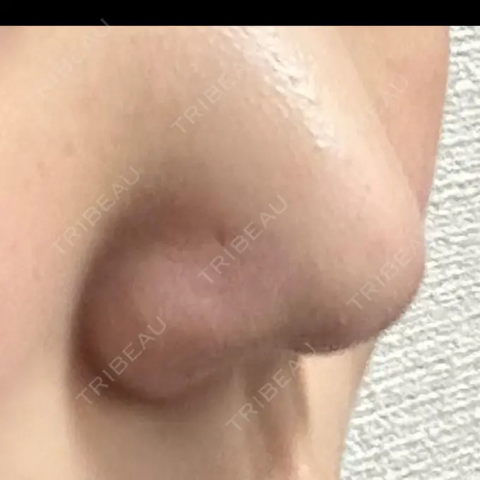 鼻尖縮小 リッツ美容外科 大阪院 DAY 6 メイン用