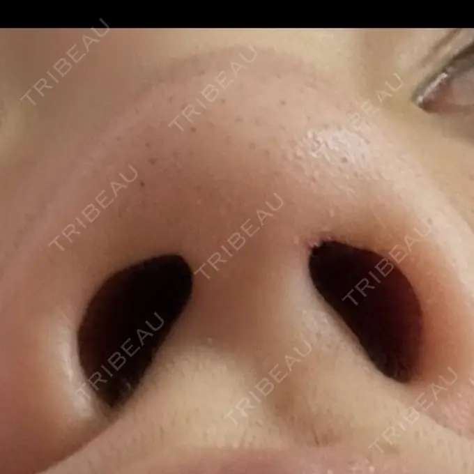 鼻尖縮小 リッツ美容外科 大阪院 AFTER メイン用