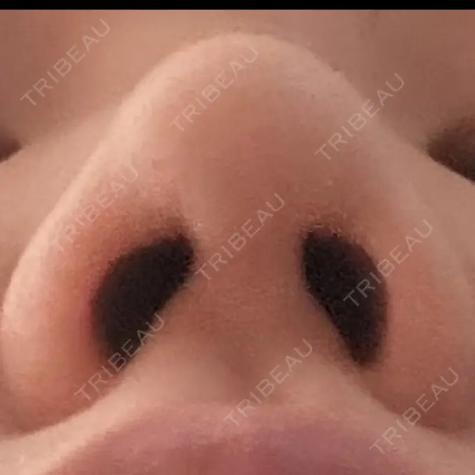 鼻尖縮小 リッツ美容外科 大阪院 DAY 14 メイン用