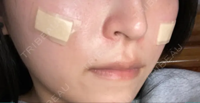 その他（鼻） ルラ美容クリニック 名古屋本院 AFTER メイン用