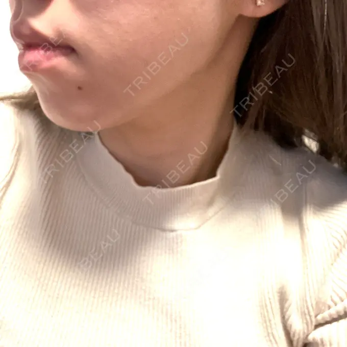 ボトックス（エラ・小顔） / ワキ汗治療（ボトックス） ネビュラクリニック 広島院 DAY 0 メイン用