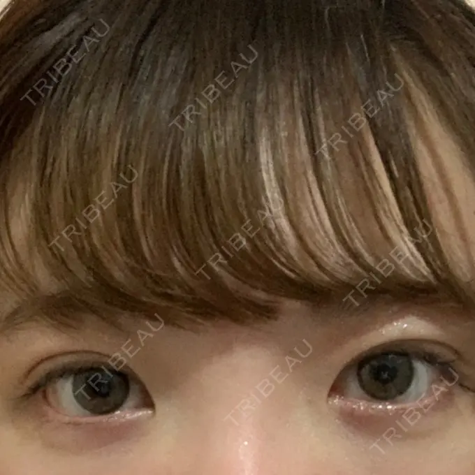 二重埋没 グランメドクリニック茨木 DAY 10 メイン用