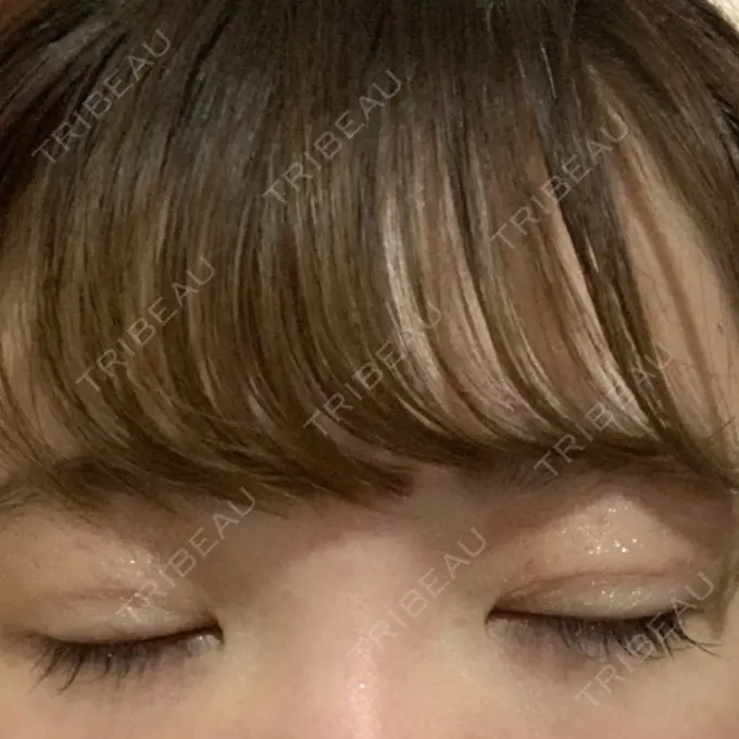 二重埋没 グランメドクリニック茨木 DAY 10 メイン用