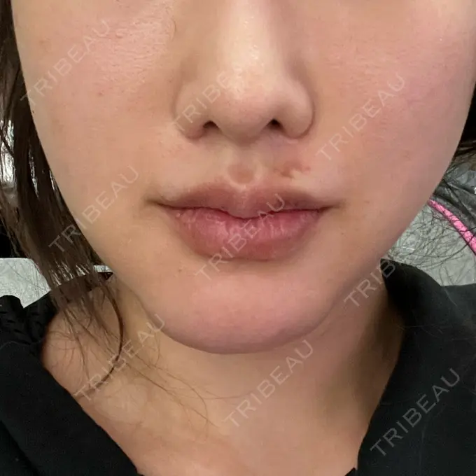 脂肪溶解注射（顔） 東京たかはしクリニック 練馬院 DAY 15 メイン用