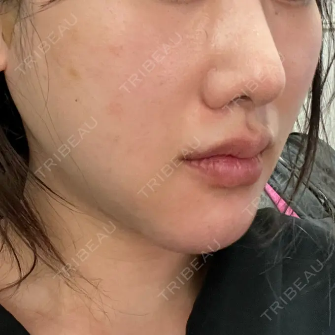 脂肪溶解注射（顔） 東京たかはしクリニック 練馬院 DAY 15 メイン用