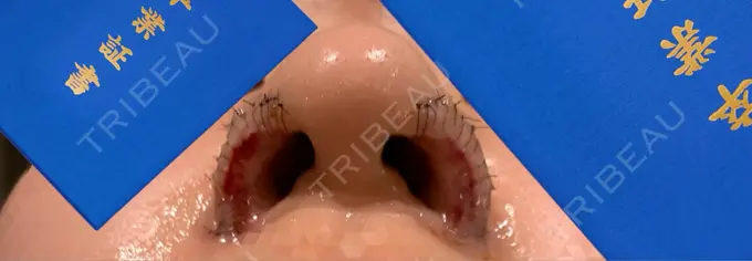 鼻孔縁挙上 シエルクリニック DAY 1 メイン用