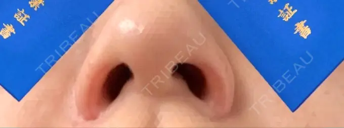 鼻孔縁挙上 シエルクリニック DAY 14 メイン用