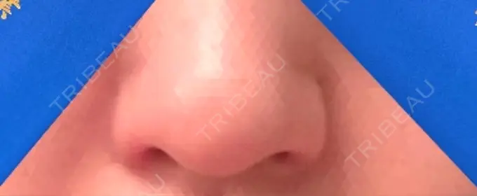 鼻孔縁挙上 シエルクリニック DAY 39 メイン用