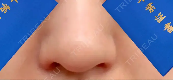 鼻孔縁挙上 シエルクリニック AFTER メイン用