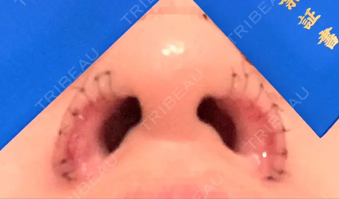 鼻孔縁挙上 シエルクリニック DAY 3 メイン用