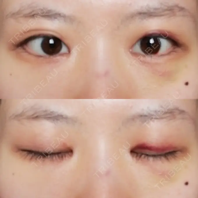 目頭切開 / 目尻切開 / 水光注射（ハリ・美肌） エートップ美容整形外科 DAY 13 メイン用