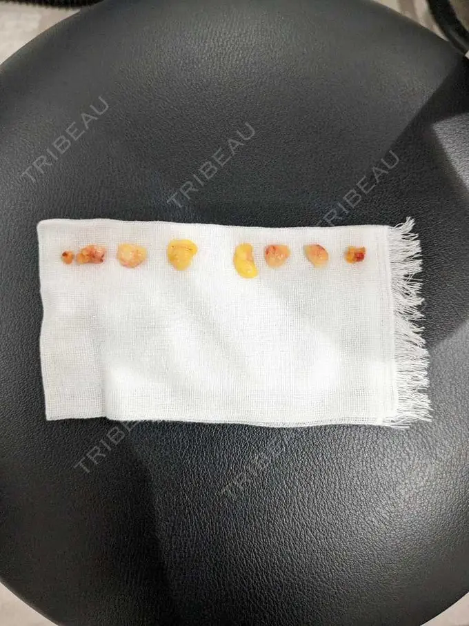 クマ治療 HAAB×DREAM BEAUTY CLINIC 大阪梅田院 DAY 0 メイン用