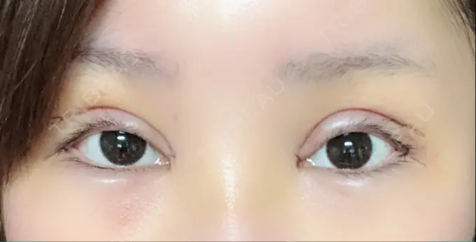 二重切開 / 眼瞼下垂（切開） / 目尻切開 / タレ目形成・グラマラスライン（切開） / 前額リフト レアート整形外科 DAY 7 メイン用