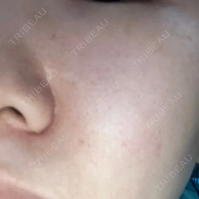 光治療（フォトフェイシャルなど） MKクリニック 日本橋院 DAY 1 メイン用