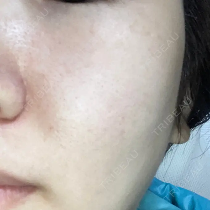 光治療（フォトフェイシャルなど） MKクリニック 日本橋院 DAY 2 メイン用