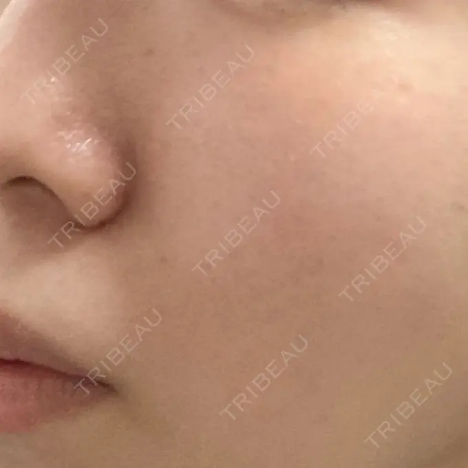 光治療（フォトフェイシャルなど） MKクリニック 日本橋院 DAY 3 メイン用