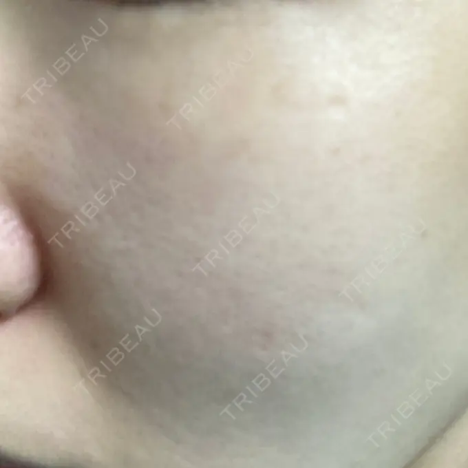 光治療（フォトフェイシャルなど） MKクリニック 日本橋院 DAY 4 メイン用