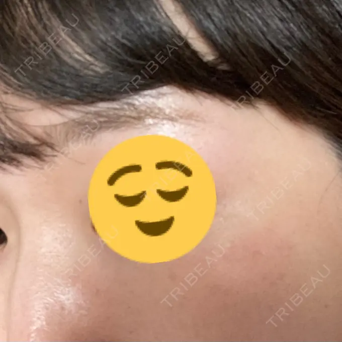 光治療（フォトフェイシャルなど） MKクリニック 日本橋院 DAY 5 メイン用