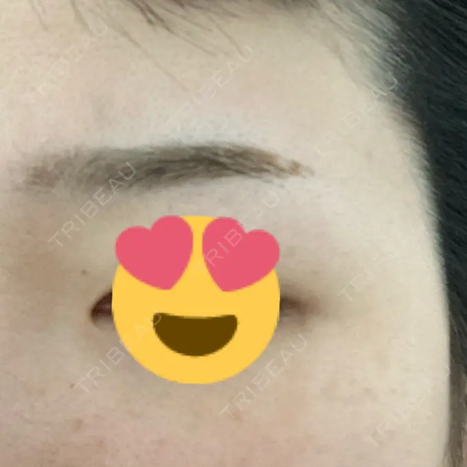 光治療（フォトフェイシャルなど） MKクリニック 日本橋院 DAY 6 メイン用