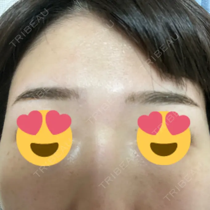 光治療（フォトフェイシャルなど） MKクリニック 日本橋院 DAY 7 メイン用