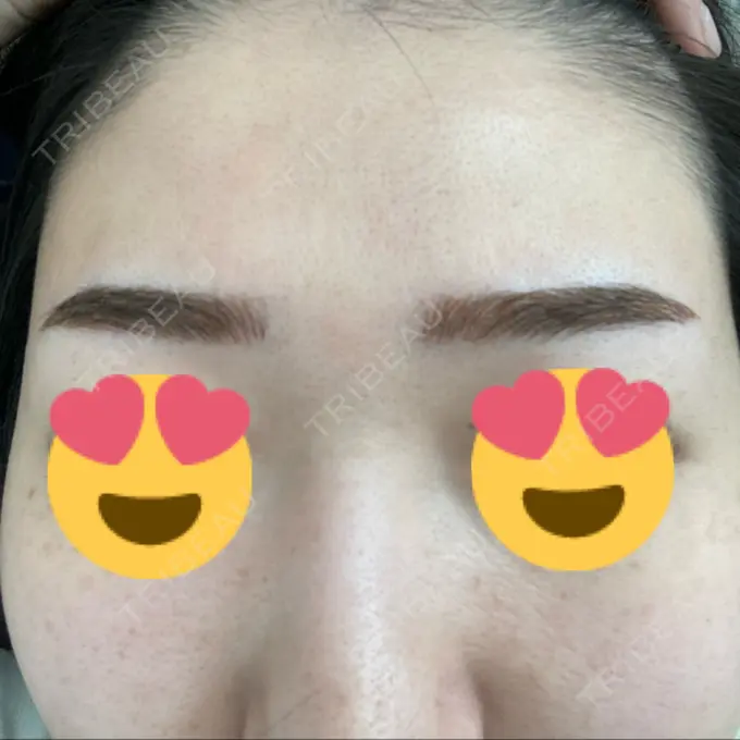 光治療（フォトフェイシャルなど） MKクリニック 日本橋院 DAY 8 メイン用