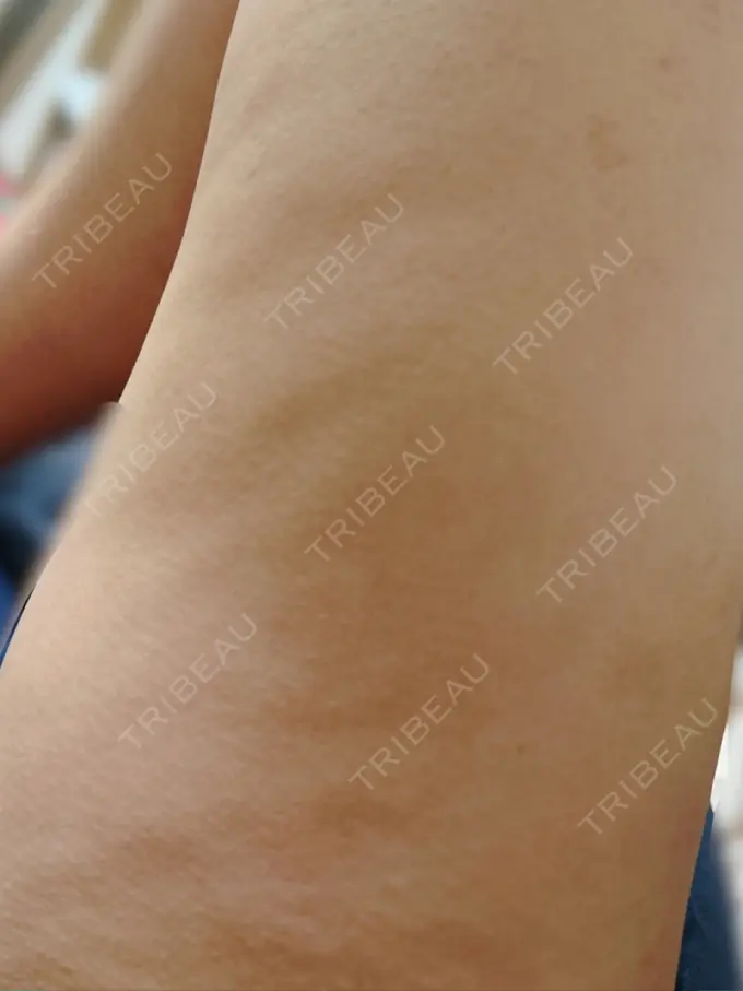 インディバ（脚） WOM SALON【術後ケア取扱いサロン】 AFTER メイン用