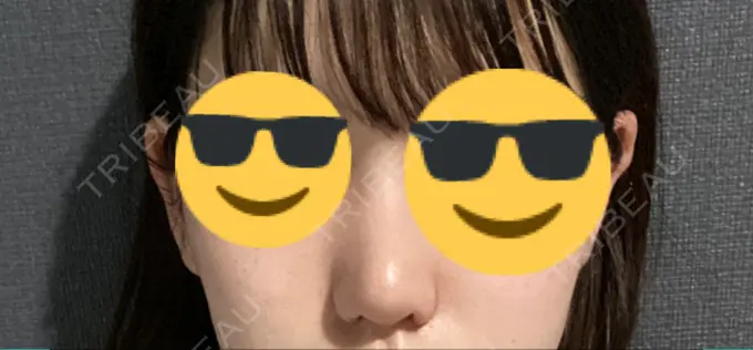 鼻尖形成（切開） / 小鼻縮小（切開） / 軟骨移植 / 鼻孔縁挙上 東京美容医療クリニック 池袋院 AFTER メイン用