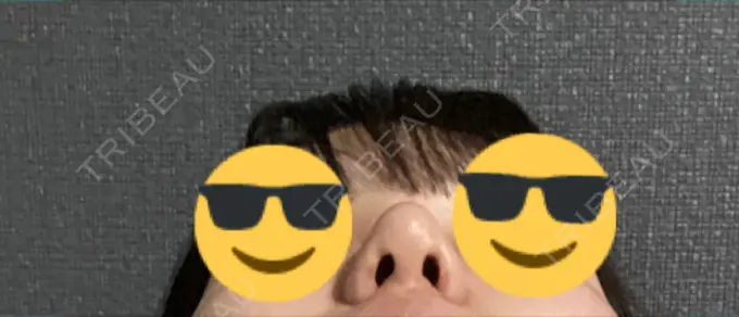 鼻尖形成（切開） / 小鼻縮小（切開） / 軟骨移植 / 鼻孔縁挙上 東京美容医療クリニック 池袋院 DAY 32 メイン用