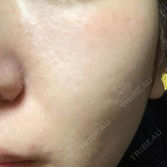 光治療（フォトフェイシャルなど） MKクリニック 日本橋院 AFTER メイン用