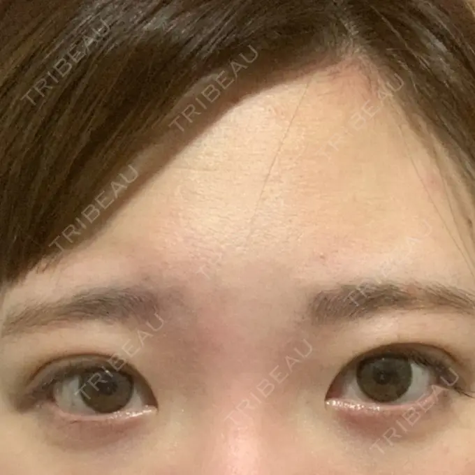 二重埋没 グランメドクリニック茨木 DAY 17 メイン用