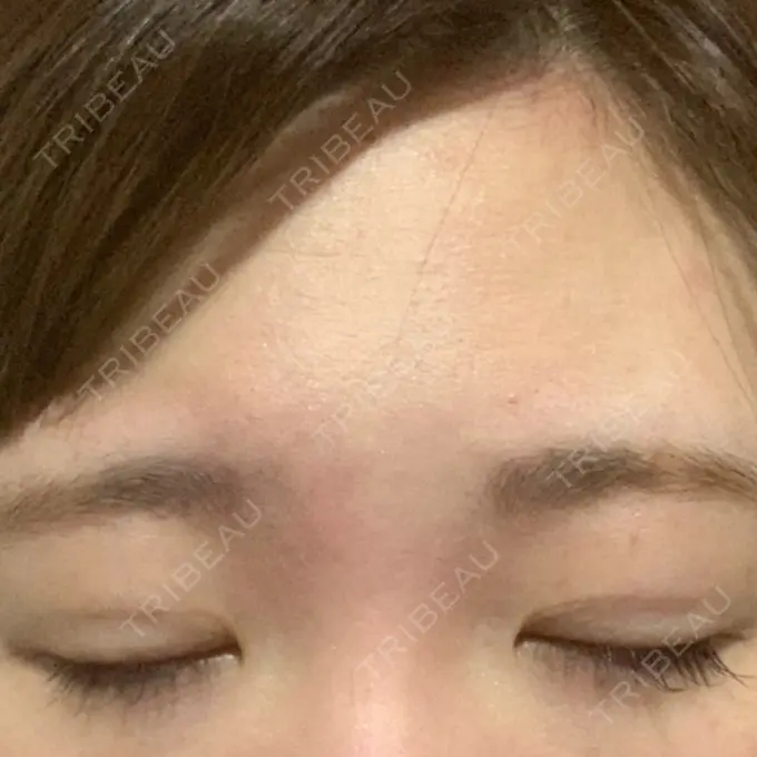 二重埋没 グランメドクリニック茨木 DAY 17 メイン用