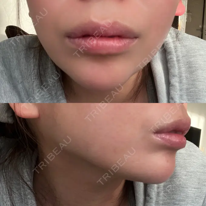 ボトックス（人中） Taide Suenaga Clinic（タイデスエナガクリニック） AFTER メイン用