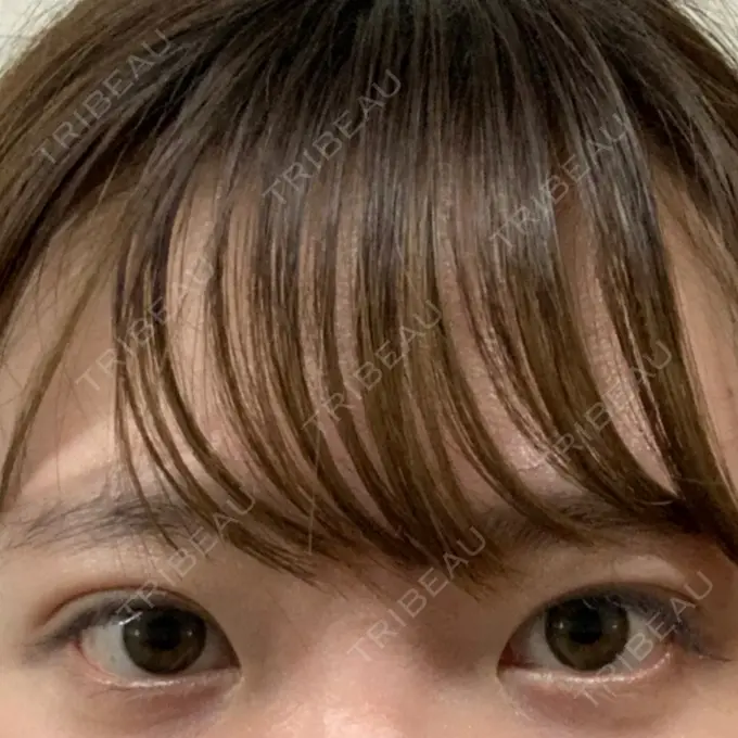 二重埋没 グランメドクリニック茨木 DAY 18 メイン用