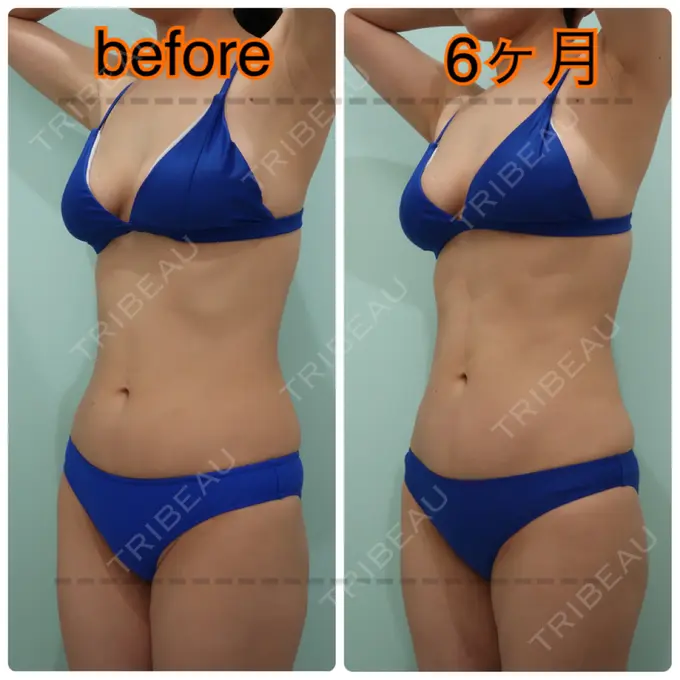 糸リフト / 脂肪吸引（顔） / 脂肪吸引（お腹） / 脂肪吸引（腰） / 脂肪吸引（背中） WOM CLINIC GINZA （ワム クリニック ギンザ） DAY 184 メイン用