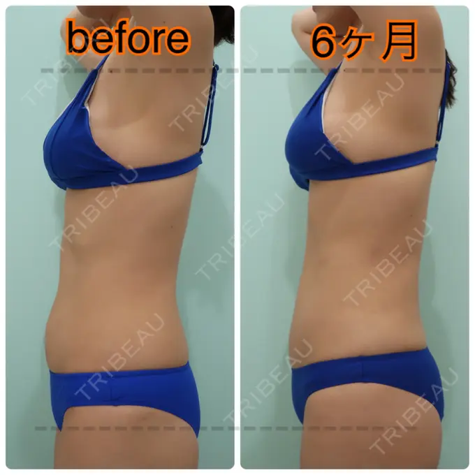 糸リフト / 脂肪吸引（顔） / 脂肪吸引（お腹） / 脂肪吸引（腰） / 脂肪吸引（背中） WOM CLINIC GINZA （ワム クリニック ギンザ） DAY 184 メイン用