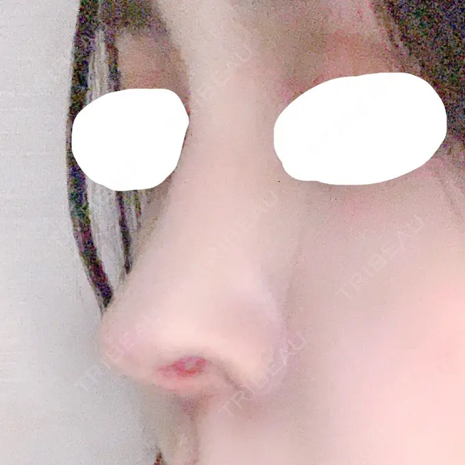 鼻中隔延長（切開） みずほクリニック DAY 16 メイン用