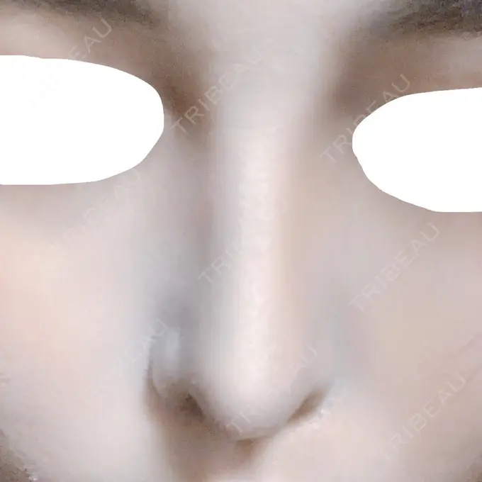 鼻中隔延長（切開） みずほクリニック DAY 16 メイン用