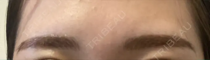 アートメイク（眉） 表参道メディカルクリニック 福岡天神院 AFTER メイン用