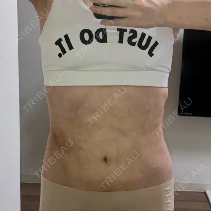 脂肪吸引（顔） / 脂肪吸引（お腹） Mods Clinic（モッズクリニック） 名古屋院 DAY 32 メイン用