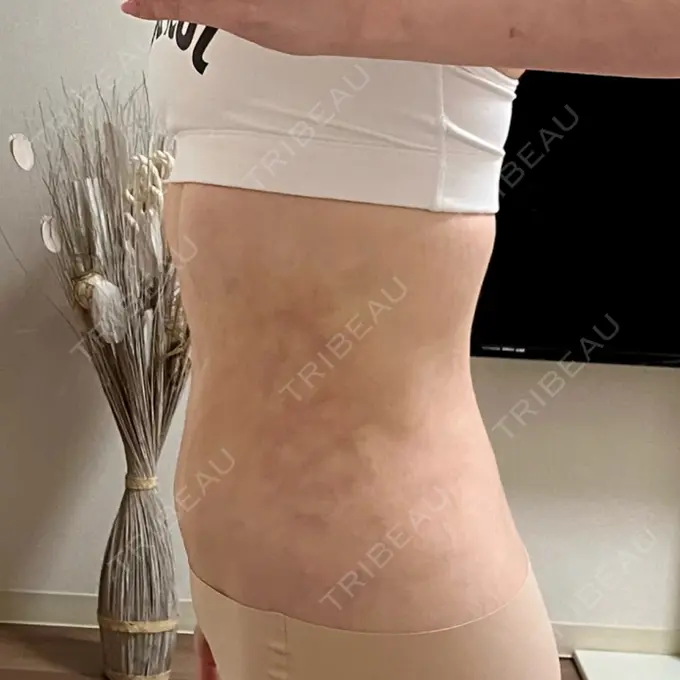 脂肪吸引（顔） / 脂肪吸引（お腹） Mods Clinic（モッズクリニック） 名古屋院 DAY 32 メイン用