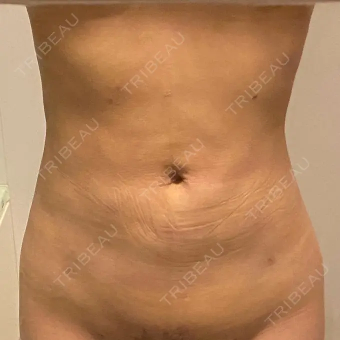 脂肪吸引（お腹） / 脂肪吸引（腰） / 脂肪吸引（背中） WOM CLINIC GINZA （ワム クリニック ギンザ） DAY 6 メイン用