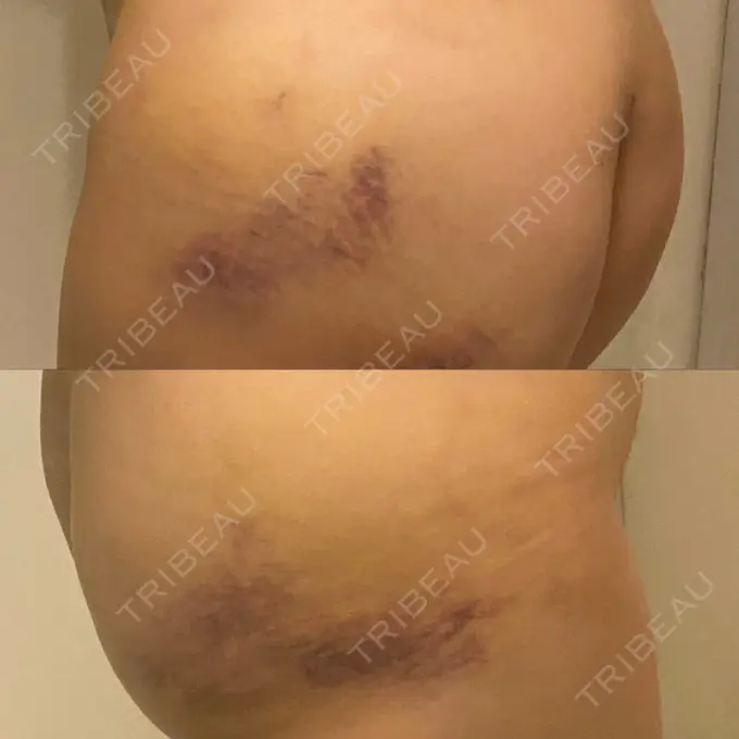 脂肪吸引（お腹） / 脂肪吸引（腰） / 脂肪吸引（背中） WOM CLINIC GINZA （ワム クリニック ギンザ） DAY 6 メイン用