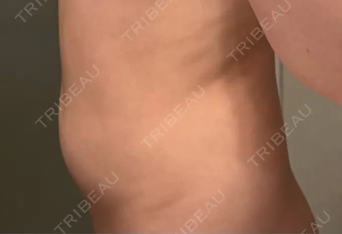 医療痩身（お腹） / 脂肪冷却（お腹） 吉祥寺アイビークリニック DAY 14 メイン用