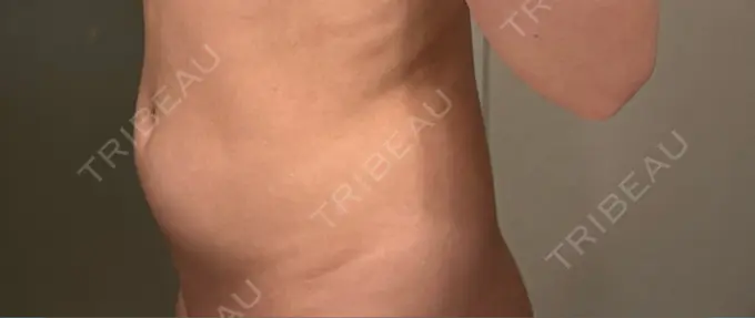 医療痩身（お腹） / 脂肪冷却（お腹） 吉祥寺アイビークリニック AFTER メイン用