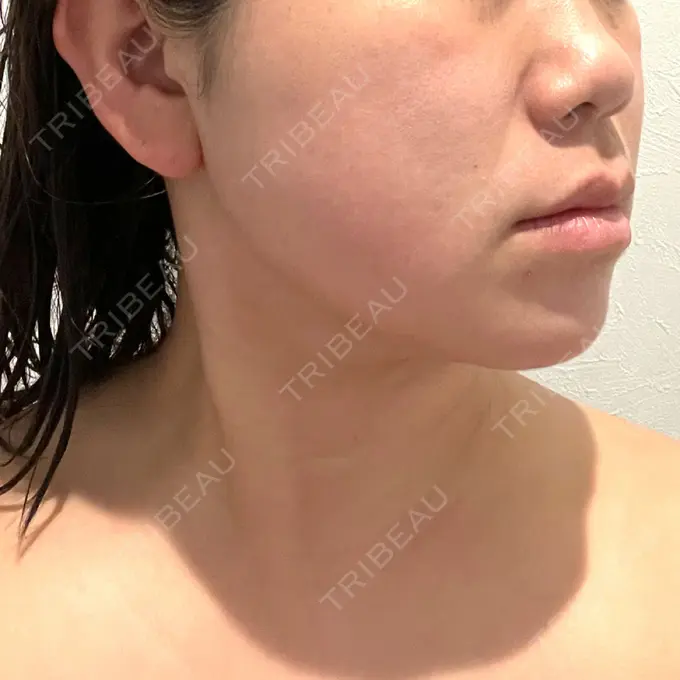 脂肪溶解注射（顔） / ハイフ（顔） ネビュラクリニック 広島院 DAY 62 メイン用