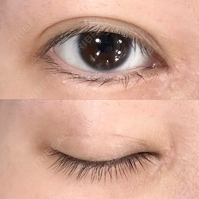 二重埋没 AI Beauty Clinic （エーアイ美容クリニック） AFTER メイン用