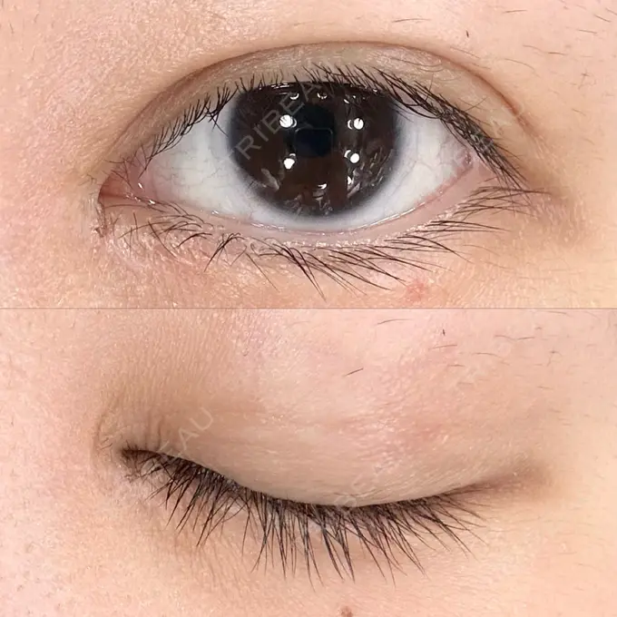 二重埋没 AI Beauty Clinic （エーアイ美容クリニック） DAY 30 メイン用