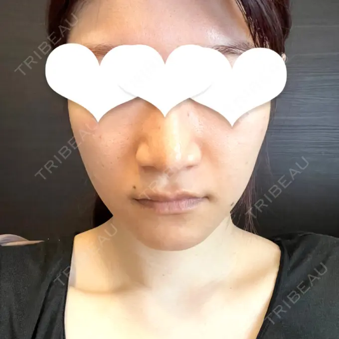 ボトックス（エラ・小顔） LOUIS CLINIC 二子玉川院【ルイクリニック】 AFTER メイン用